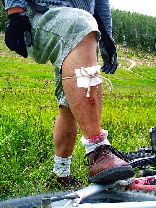 Improvised first aid in the outdoors. By Greg Younger (Flickr)