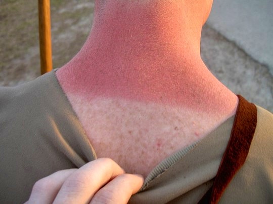 Sunburn will happen without sunscreen. By Phil Kates (Flickr)